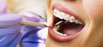How to relieve back pain naturally. Dental Braces Treatment Details Removal Recovery