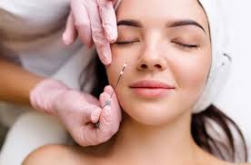 cấy chỉ collagen làm đầy má hóp có an toàn không?