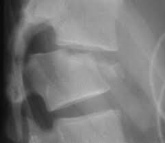 Maybe you would like to learn more about one of these? Fracture Des Vertebres Docteur Jacques Samani
