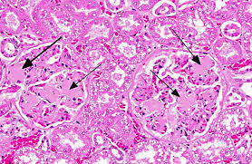 Al amyloidosis (also called primary amyloidosis) is a blood illness in which a special protein builds up in various parts of the body. Conference 10 2012 Case 01 20130102