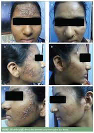 Benzoyl peroxide versus topical erythromycin in the treatment of acne vulgaris.br j dermatol. Efficacy And Safety Evaluation Of High Density Intense Pulsed Light In The Treatment Of Grades Ii And Iv Acne Vulgaris As Monotherapy In Dark Skinned Women Of Child Bearing Age Jcad The