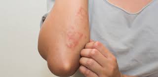 Distinguishing one rash from another ensures you get the right treatment fast. Common Skin Rashes And What To Do About Them