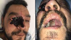 La mucormicosis rinoorbitocerebral es una infección oportunista y altamente letal; La Mucormicosis La Terrible Infeccion Por Hongos Que Destruye El Tejido Humano Salud Y Bienestar Total