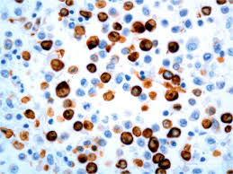 Patil, director, national research centre on camel, bikaner for providing necessary infrastructure and resources to. Brain Tumours In Two Bactrian Camels A Histiocytic Sarcoma And A Meningioma Molenaar 2009 Veterinary Record Wiley Online Library