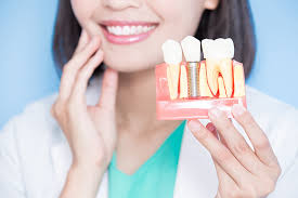 Does insurance cover tooth implants. How Much Do Dental Implants Cost Lowell Dental Arts