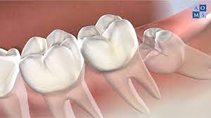 Wisdom Teeth Removal Post Operative Instructions At Amarillo Oral Maxillofacial Surgery