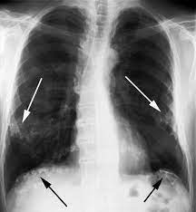 Chest pain as a result of pleural plaques can be . Asbestos Related Pleural Disease Pulmonary Disorders Msd Manual Professional Edition