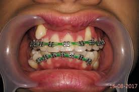 Harga atau biaya cukup beragam, di klinik bisa mencapai 2 jutaan sedangkan di puskesmas tentu akan lebih terjangkau lagi. Fake Braces Jauhi Doktor Gigi Yang Memasangkan Pendakap Gigi Secara Haram Theasianparent Malaysia