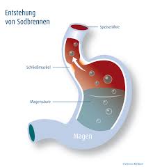 Tritt sodbrennen häufiger auf, sollten sie die ursachen ärztlich abklären lassen. Gesundheitsverzeichnis Gesundheitsverzeichnis 24 Gesundheitsportal