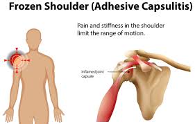 Image result for Frozen Shoulder