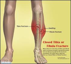Closed Tibia Or Fibula Fracture Broken Fibula Fracture Broken Leg