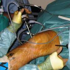 Maybe you would like to learn more about one of these? Arthroscopic Knee Surgery The Knee Doc