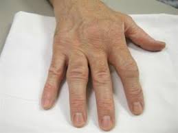 Rheumatoid Arthritis Division Of Rheumatology University Of Washington