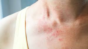 Image result for sweat rash on back