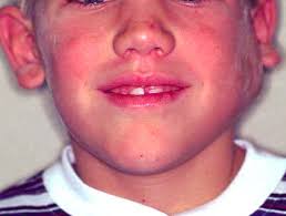 Image result for phlegmon on face)