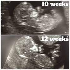 First trimester 12 week ultrasound nuchal translucency (nt) scan. Life Unexpected January 2020