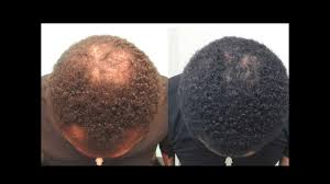 Other options include light therapy, hormone therapy. Hair Loss Treatment For Men Without Surgery Youtube