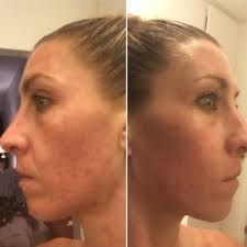 It also lists some alternative treatment options and skin care brands to consider. Curology Review For Acne 5 Week Results