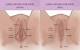 Ingrown Hair How To Remove