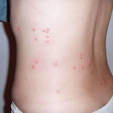 Flea Bites That Look Like Mosquito Bites Pin On Know Your Body