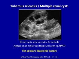 Tuberous Sclerosis Renal Cysts And Usually Angiomyolipomas Tuberous Sclerosis Kidney Cyst Ultrasound Sonography