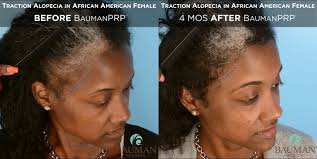 Target areas of the disease include the face, chest, pubic area, back and scalp. Traction Alopecia In African American Baumanprp Bauman Medical