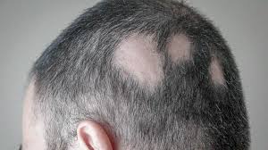Scalp psoriasis involves skin changes on the scalp and around the hairline. Scalp Conditions Examples Treatment And Pictures