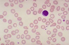 Image result for Anemia schimperiana