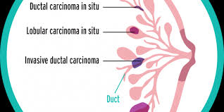 There are various types of breast cancer, and they are. Common Types Of Breast Cancer Presentations Emabal Hospitals Limited
