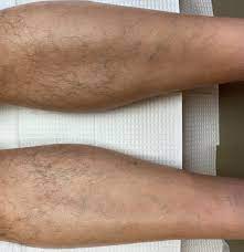 Talk to a doctor if you need help controlling your blood sugar. Anterolateral Leg Alopecia An Example Of A New Dermatologic Statistic Seen But Unrecognized