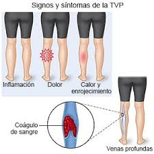 Suele ser profunda y se encuentra siempre en lugares de una mala circulación sanguínea, es decir a nivel de las pantorrillas o de los muslos. Trombosis Venosa Profunda Care Guide Information En Espanol