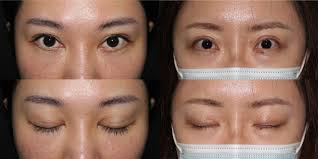 A Modified Procedure for Single-eyelid Asian Females with Lacrimal Gland  Prolapse: Lacrimal Gland Reposition combined with Fat Transposition in  Double-eyelid Operation