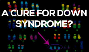 Is There A New Cure For Down Syndrome Johns Hopkins Researchers Think So