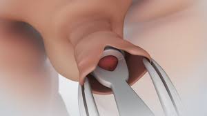 That really bothers me and i have not heard of an elective circumcision done at. Circumcision Nucleus Health Youtube