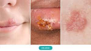 Herpes During Pregnancy Symptoms Causes Risks Treatment