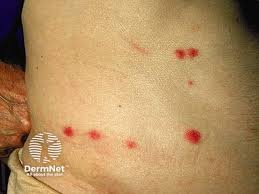 Image result for flea bites