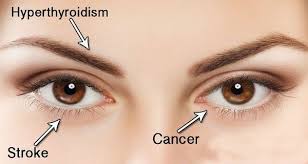Eye cancer happens when there is an abnormal growth of malignant cells in the eye. 14 Things Your Eyes Can Tell You About Your Health If You Know What Look For Human Brain Facts Brain Facts Eye Exercises
