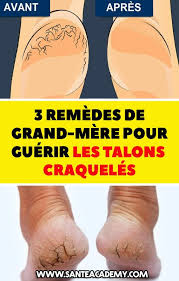 3 Remedes De Grand Mere Pour Guerir Les Talons Craqueles Grand Mere Remedes Talons Sante Remedemaison Fruit Cantaloupe Mom