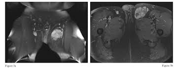 Image result for Leiomyosarcoma