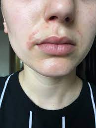 Selfie I Chose To Wax The Same Week I Started Retinoids Regerts Skincareaddiction