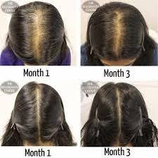 Hair can thin for a number of reasons. 7 Pcos Ideas Natural Hair Loss Treatment Natural Hair Loss Hair Loss Treatments