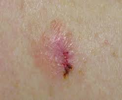 Use the menu to see other pages.staging is a way of describing where the cancer is located, if or where it has spread, and whethe. Amelanotic Melanoma Pictures