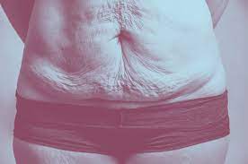 Methods To Remove Excess Skin