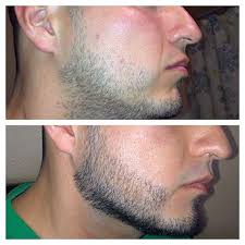 Can you apply minoxidil more for faster growth? Kirkland Minoxidil Beard Results Kirkland Minoxidil Before And After Beard Beardstyleshq Kirkland Minoxidil For Beard Beardstyleshq