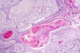 Carcinoma in situ refers to a group of abnormal cells that have not spread from the location where they first formed, although they may later spread into normal tissue and become cancer. Diet May Impact Squamous Cell Carcinoma Risk