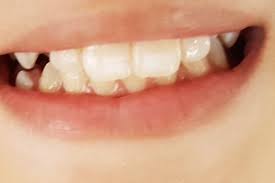 Repair White Spots White Marks On Teeth With Remineralising Toothpaste