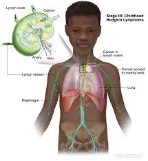 Image result for Lymphoma