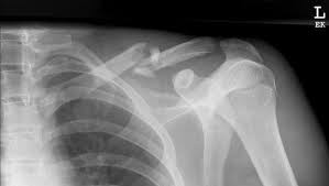 Bones • sternum • clavicles • scapulae • ribs • spine. Clavicle Fractures Litfl Trauma Library