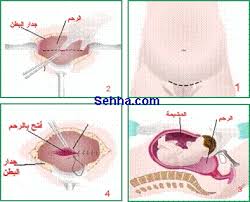 Check spelling or type a new query. Ø§Ø³Ø¨Ø§Ø¨ Ø¶Ø¹Ù Ø§Ù„Ø±Ø­Ù… Ø¹Ø§Ù„Ù… Ø­ÙˆØ§Ø¡ Ø§Ø³Ø¨Ø§Ø¨ ØªØ§Ø®Ø± Ø§Ù„Ø­Ù…Ù„