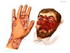 Lupus vulgaris is usually progressive if untreated, as are most cases of tuberculosis verrucosa cutis, and scrofuloderma. Cutaneous Tuberculosis Illustration Stock Image C030 8489 Science Photo Library